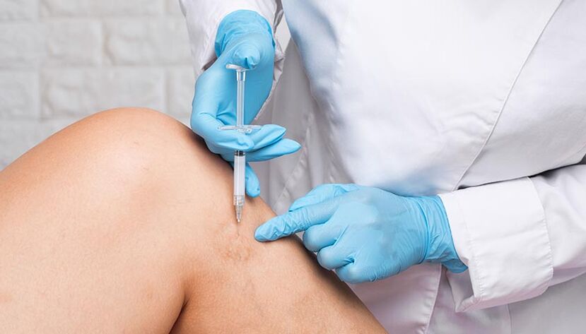 barizeetarako eskleroterapia prozedura