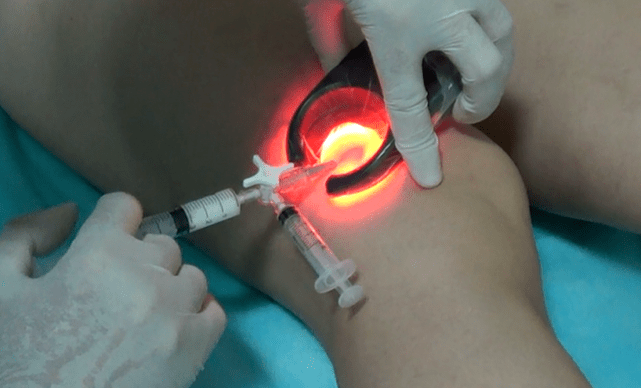 Eskleroterapia hanketako barizeak tratatzeko metodo eraginkorra da